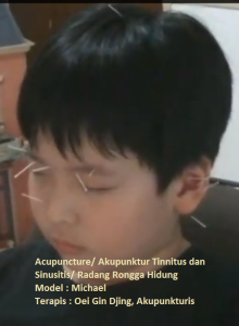 Terapi akupunktur untuk Tinnitus dan Sinusiris oleh Oei Gin Djing, Acp